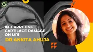 DR ANKITA AHUJA | INDIANRADIOLOGIST JOURNAL CLUB | Interpreting Cartilage Damage on MRI