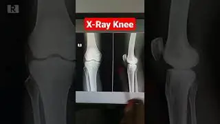 Digital X-Ray Knee Joint #Normal #shots