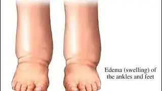 Maternal edema;  swelling caused by fluid retention during pregnancy
