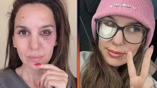 Christy Carlson Romano Reveals She Was Shot in the Face
