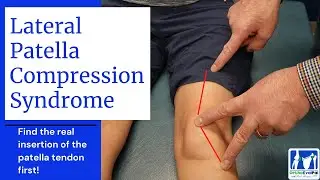 Lateral Patella Compression Syndrome (LPCS)
