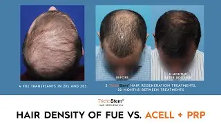Factors in Choosing FUE Hair Transplant, or ACell PRP Treatment