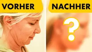 Sie zeigt ihr Facelift 10 Tage nach OP spontan vor der Kamera! Dr. Jungwirth - Plastische Chirurgie