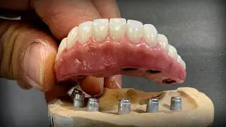 Making a Removable Zirconia Restoration with Locators&reg;