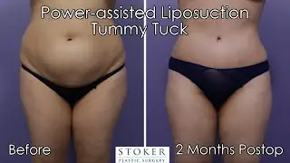 Tummy Tuck and Liposuction by Los Angeles Plastic Surgeon Dr. David Stoker