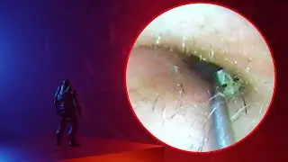 The Truth About earwax Will Shock You. How to remove earwax from ear, earwax extractions