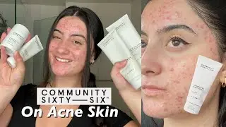 TESTING NEW COMMUNITY 66 SKINCARE ON ACNE PRONE, SENSITIVE SKIN | Retinol Night Cream 2 Week Test