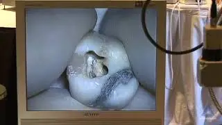 Access Preparation Massive Stone Removal: Advanced Endodontics