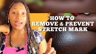 How to get rid of stretch marks|CAUSES & TREATMENT+BEST PRODUCT TO USE #stretchmark #skincare #viral