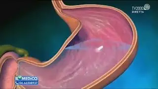 Il Mio Medico - Reflusso addio!