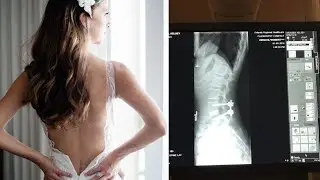 How Bride Showcased Scar From Major Spinal Surgery on Wedding Day