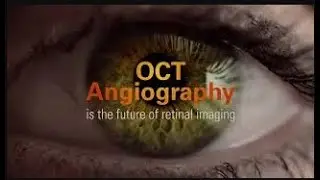 OCT Angiography (OCTA) by Optovue
