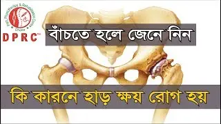 Calcium। Bone disease। Joint disease। হাড় ক্ষয় রোগ হলে কি ক্যালসিয়াম এর অভাব? আসল কথা জানুন