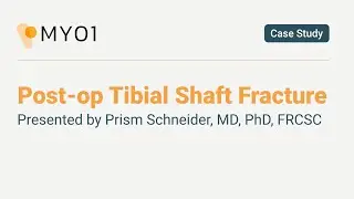 Dr. Prism Schneider talks about a Post-op Tibial Shaft Fracture case