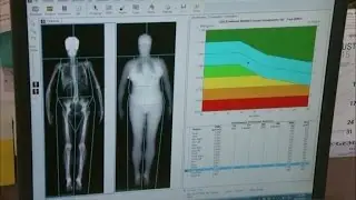 Fat scanner reveals hidden risks