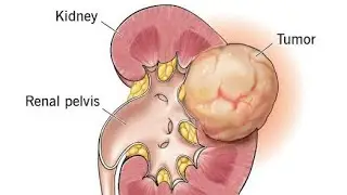 Kidney Cancer/ Renal Cell Carcinoma (RCC) Shorts