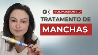 Microagulhamento para MANCHAS : O Que Funciona (E O Que Pode PIORAR!)