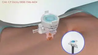 Operasi Laparoscopic Trocar