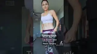 TUMMY TUCK SCAR 2 months post surgery. #plasticsurgery #tummytuckscar