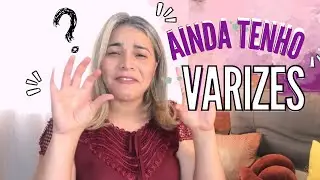 COMO ESTÃO MINHAS PERNAS APÓS O TRATAMENTO DAS VARIZES | DIÁRIO DA ESCLEROTERAPIA COM ESPUMA