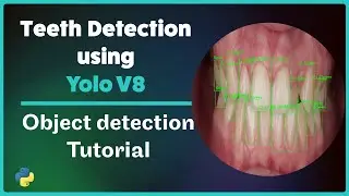 Teeth Detection using Deep learning | Yolo V8