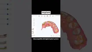 What COXO DL-300P Intraoral Scanner Can Scan?(Real Examples)
