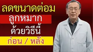 ในฐานะแพทย์ทางเดินปัสสาวะ ผมขอบอกตรงๆ: นี่คือวิธีที่ดีที่สุดในการป้องกันต่อมลูกหมากโต