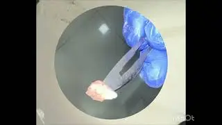 Sebaceous Cyst Removal #dermatologist #chembur#southmumbai#santacruz#mumbai#painlesssurgery#goodskin
