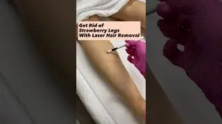 #Laserhairremoval reduces strawberry legs by eliminating ingrown hairs and minimizing visible pores