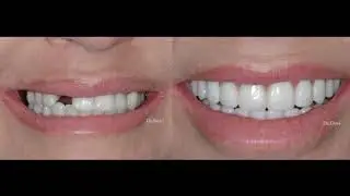 Best ALL ON 4 Implant Dentist in Arizona | Dr. Devi DDS.MS.FICOI