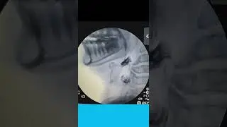 VFSS( Video Fluoroscopic Swallow Study)