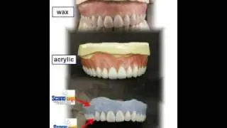 Matrix Dental Lab....Raising the Bar in Removable Prosthetics