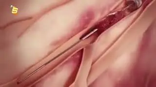 New technology for heart attack surgery | SVIEW