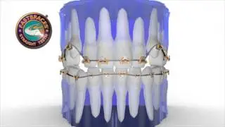 Fastbraces&reg; Technology: High Canines