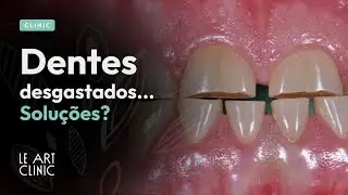 Dentes desgastados? Conheça as soluções disponíveis!