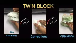 TWINBLOCK #DRgigiRK #csdc ##twinblock #serembandentalclinic #dentist #staypositive #YouTube