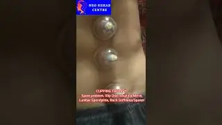 कपिंग से कमर के दर्द का इलाज #ytshorts #slipdisc #shortvideo #Spine problem