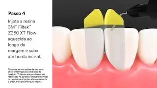 M&eacute;todos Bioclear&trade; 3M - Black Triangle Space, Passo a Passo da Pr&aacute;tica para os Tri&acirc;ngulos Pretos