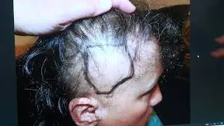 1-Year Hair Transplant Follow-Up | Natural, Dense Results for Female Hair Loss