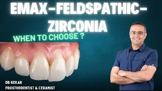 Which Dental Material to Choose? | Feldspathic vs LiSi2 vs Zirconia Explained