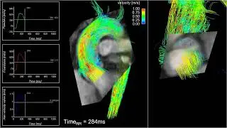 Aortic 4D flow MRI   3D blood flow visualization & quantification in aortic valve insufficiency fqbj