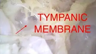 TYMPANIC MEMBRANE