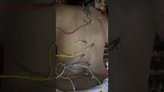 Физиотерапия при шейном спондилезе и поясничной радикулопатии в клиниках IM WELL CLINICS