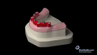 UCLA Overdenture Bar