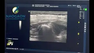Erector Spinae Plane Block(ESPB) #ESPB#prp #usg #drmosharafhossain #backpain #backpainrelief