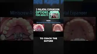 3 Palatal Expansion Options for Adults