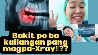 Kahalagahan Ng Dental Xray at Ang ibat ibang uri nito.