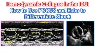 Hemodynamic Collapse in the ICU: How to Use POCUS and Echo to Differentiate Shock
