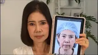พี่แหวว อายุ 60 ปี ใครเห็นก็จำไม่ได้ เฟซล็อคสองช่วง เหนียง มัลติเซล 6 เดือน โรงพยาบาลธีรพร หมอชลธิศ