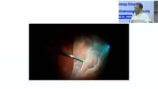 AIOS2025 GP89 T Dr Satya Prakash TIWARY Management of Complex Retinal Detachment
